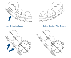 Improved cuspid-to-lateral and bicuspid-to-molar transitions eliminate the need for common first-order bends