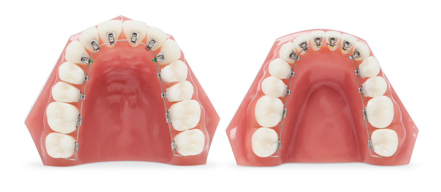 Alias Lingual Straightwire Calmal Dental Damon Braces Locator Malaysia