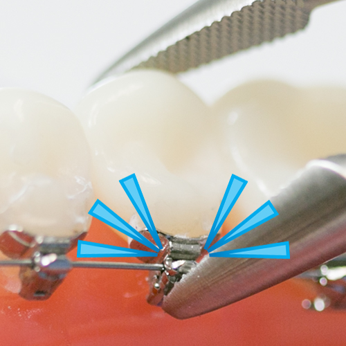 Alias Lingual Straightwire Calmal Dental Damon Braces Locator Malaysia